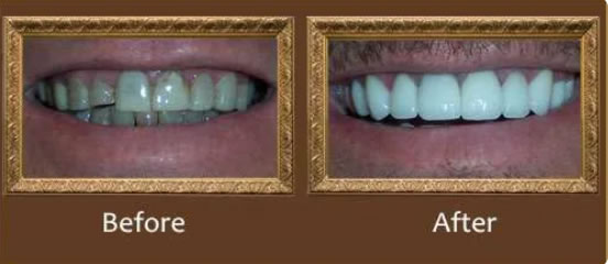 implants_greenacres dentures_greenacres